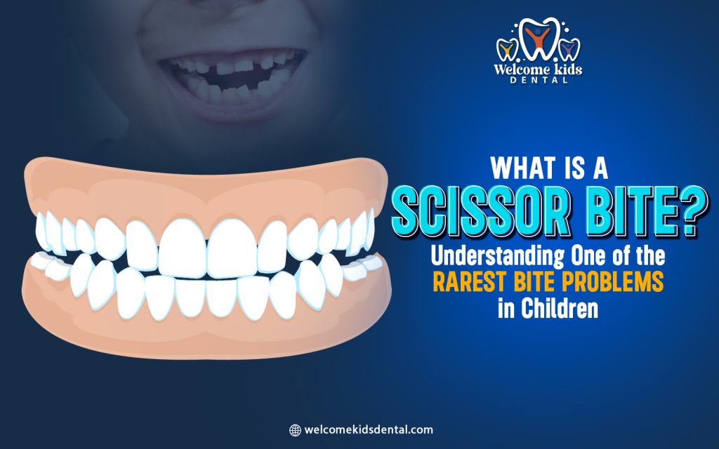 What Is a Scissor Bite? Understanding One of the Rarest Bite Problems in Children