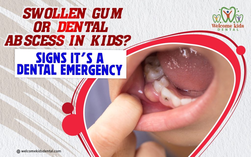 Swollen Gum or Dental Abscess in Kids? Signs It’s a Dental Emergency