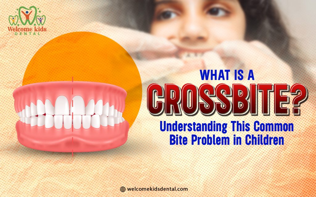 What Is a Crossbite? Understanding This Common Bite Problem in Children