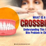 Thumbnail for What Is a Crossbite? Understanding This Common Bite Problem in Children